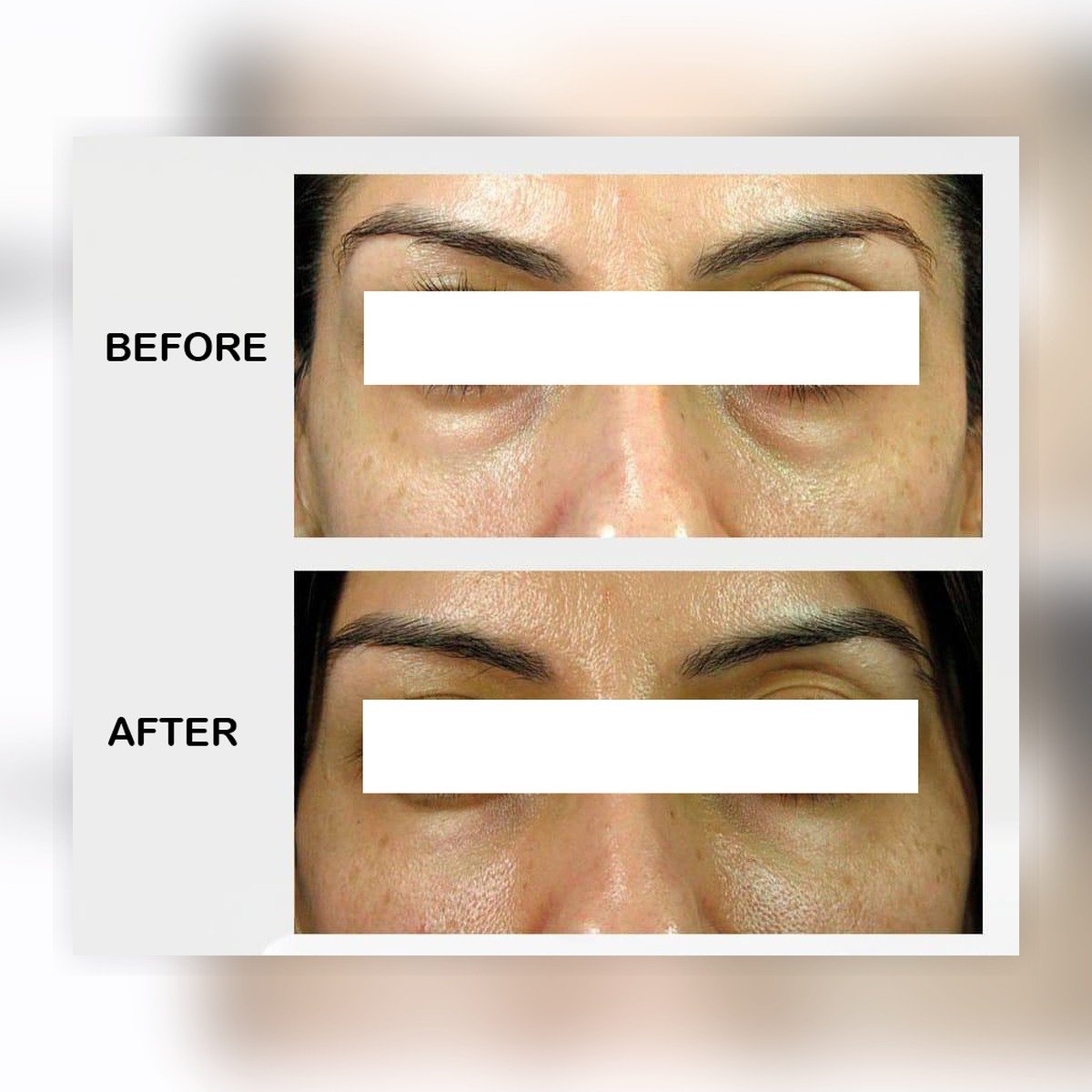 before after serum mata kantung mata lingkaran hitam eye contour