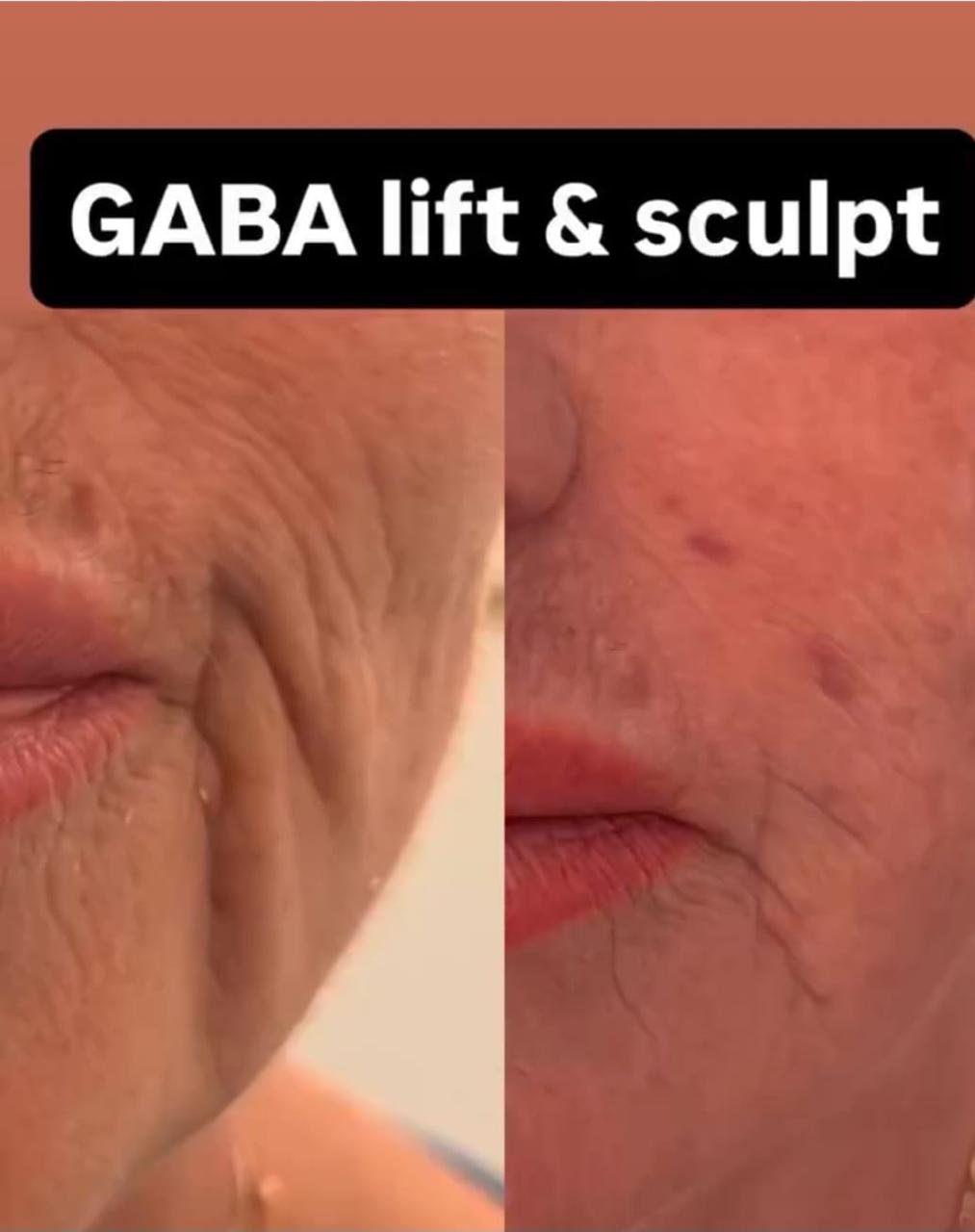 before after serum lifting kontur wajah garis ekspresi gaba lift sculpt