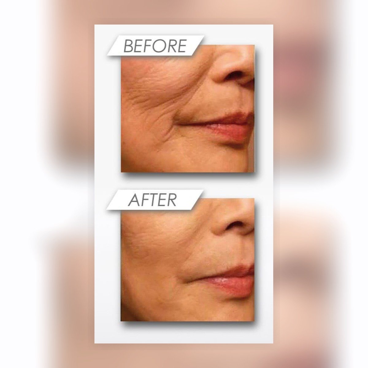 before after serum anti aging skinbooster md:complex genx