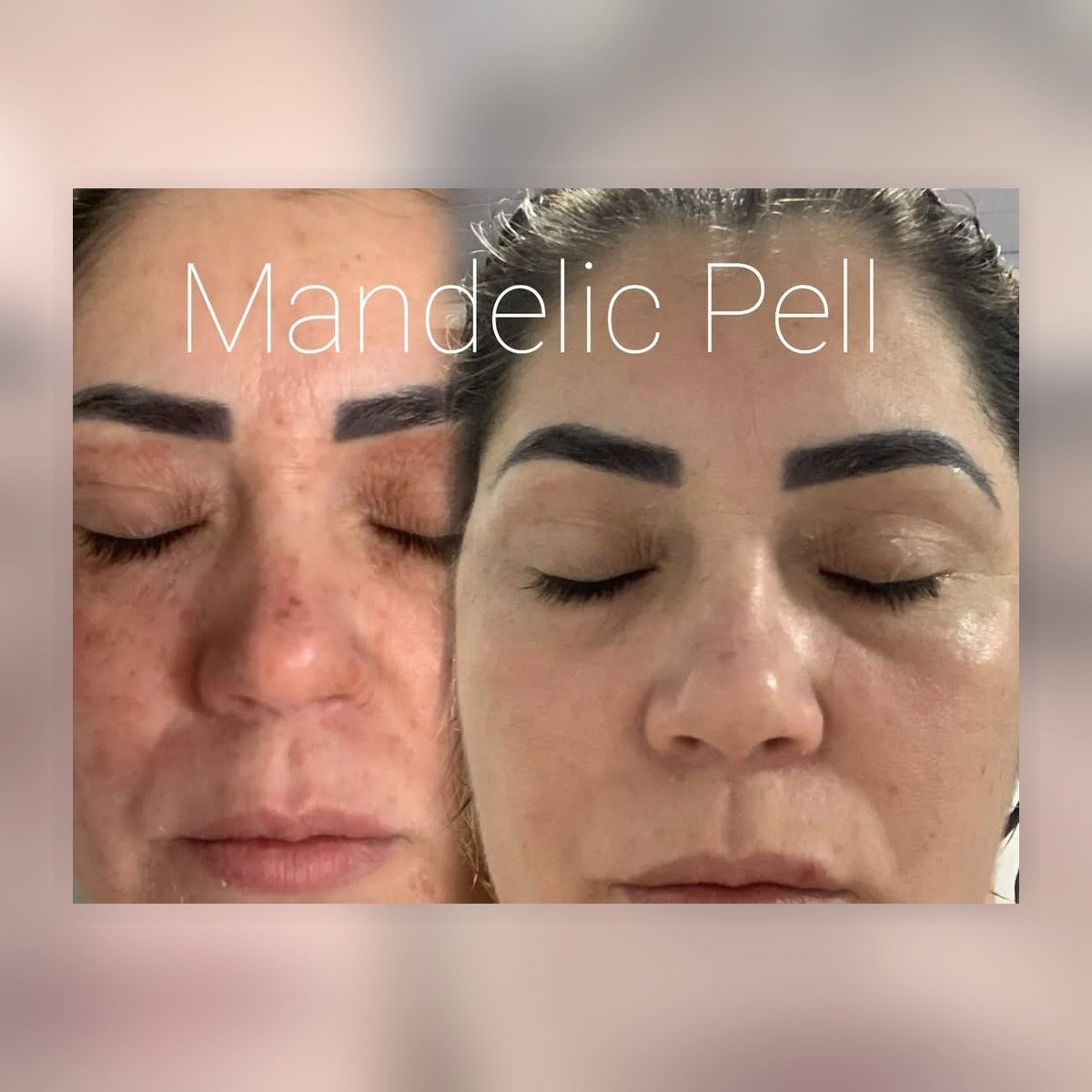 before after chemical peeling mandelic 40 kulit sensitif