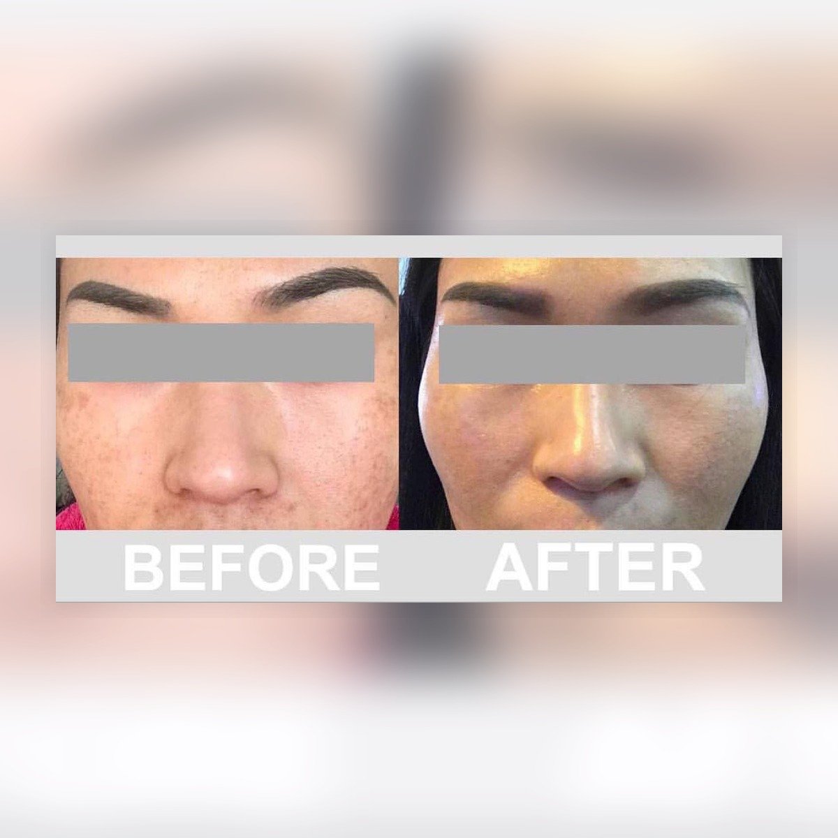 before after serum pencerah melasma hiperpigmentasi melan:off