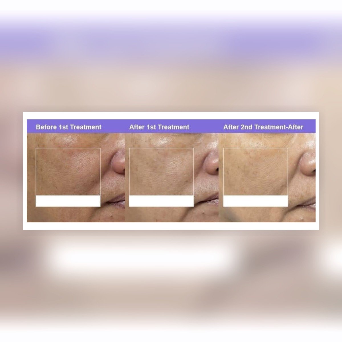 before after serum polynucleotide regenerasi kulit md:ceuticals