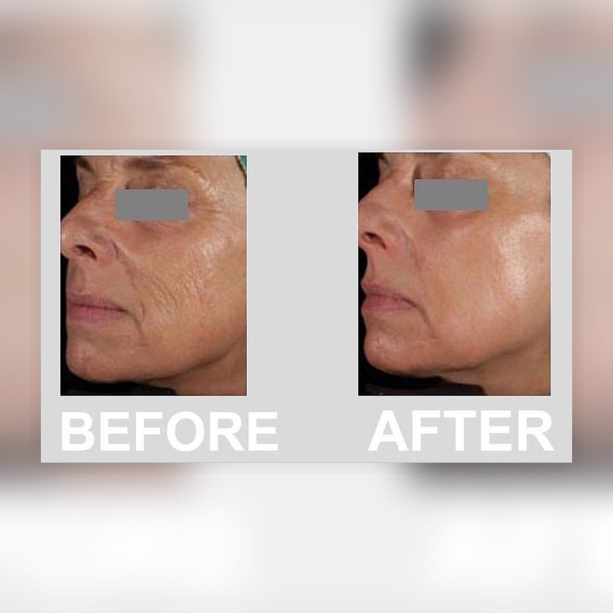before after chemical peeling pyruvic lactic regenerasi kulit