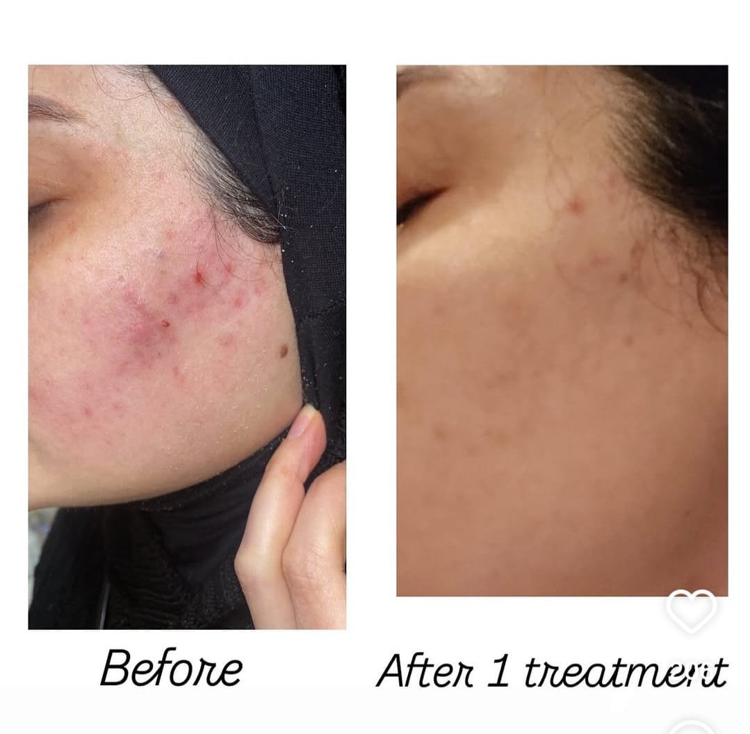 before after serum jerawat kulit berminyak bekas jerawat skinclear