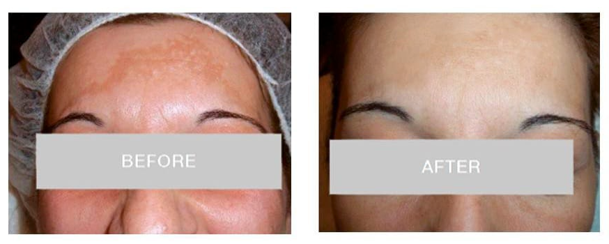before after peeling tranexamic retinol hiperpigmentasi md:tranex retipeel